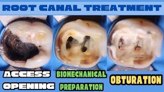 Root Canal Treatment 🔵 Mandibular Molar 🟡Access Opening🟢Biomechanical Preparation ⚪️ Obturation [upl. by Bisset]