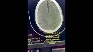 Subdural Hematoma SDH  slight head injury can lead hemorrhage hemorrhage headinjury ctbrain [upl. by Oynotna]