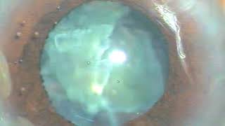 Phaco with severe floppy iris without using Pupil dilating devices  P Mohanta [upl. by Oira]