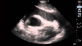 Case of the Month 4  Subcostal 4 chamber [upl. by Roane]