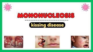 Mononucleosis infection epstein barr virus pathophysiology symptoms diagnosis treatment [upl. by Garzon436]