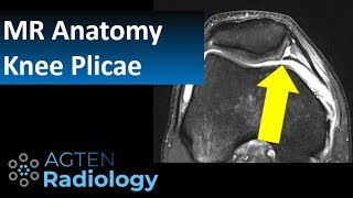 MRI Anatomy of Knee Plicae [upl. by Ellocin]