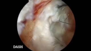 Endoscopic Biportal discectomy for a large l34 central tongue shaped discDr Atmaranjan [upl. by Yahska]