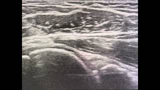 Ultrasound guided glenohumeral joint needle placement posterior approach [upl. by Gerc]