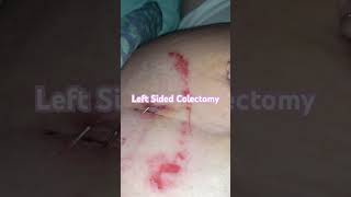 Left Sided Lower Colectomy Sigmoid Colon Incision Medical Surgery [upl. by Chuck]