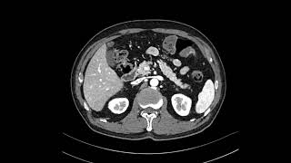 GB adenomyomatosis [upl. by Nevanod]