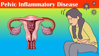 Pelvic Inflammatory Disease PID  Causes Signs amp Symptoms Diagnosis And Treatment [upl. by Enylcaj]