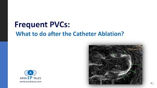 Risk Stratification after Catheter Ablation of Frequent PVC [upl. by Aenet]