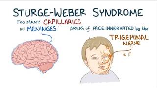 sturgeweber syndrome [upl. by Ayatahs]