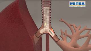 Tracheobronchial quotYquot stent MITRA OTTOMED ENDOSCOPY Interventional Pulmonology [upl. by Pliner245]