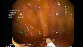 FLAT POLYP OF THE COLON REMOVAL CHRISTOS KARALIS MDwmv [upl. by Neff]