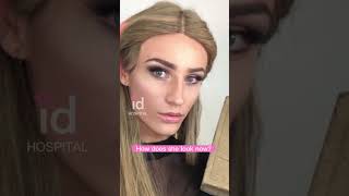 Amazing Facial Feminization Surgery Transformation idhospital shortsfeed [upl. by Teerprug]