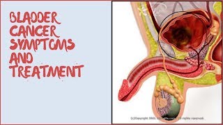 BLADDER CANCER SYMPTOMS AND TREATMENT [upl. by Onez]