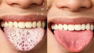 Get rid of White coated Tongue Naturally at Home Get Pink Tongue [upl. by Kcerred]