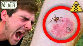 BROWN RECLUSE BITE What Happens [upl. by Adnov]