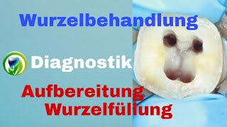 Wurzelbehandlung  Ablauf Diagnostik  Wurzelkanalaufbereitung  Wurzelfüllung [upl. by Lenox]