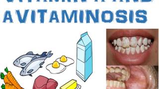 Vitamin A  Synthesis Regulation Functions Deficiency and hypervitaminosis [upl. by Ial303]