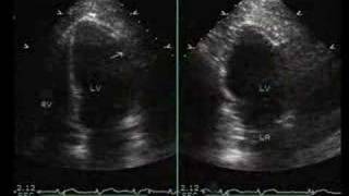 InferiorPosterior and Lateral Myocardial Infarction [upl. by Corabel614]