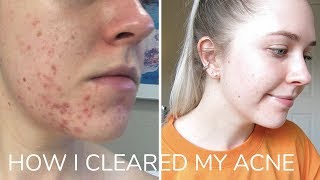 How I Cleared My Acne [upl. by Jeana209]