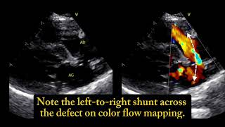 Ostium secundum atrial septal defect a 6 monthold cat 🐱 [upl. by Rohclem754]