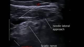 sciatic popliteal nerve block [upl. by Esinrahs213]