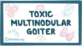 Toxic multinodular goiter  causes symptoms diagnosis treatment pathology [upl. by Elrebmik]