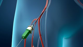 Coronary Angioplasty Femoral Access [upl. by Airbmac562]