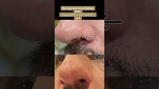 Skin tag removal ازالة الجلد الزائد [upl. by Kcirderf825]