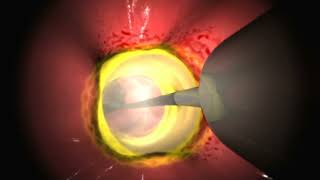 Radiofrequency ablation of the esophagus [upl. by Boot163]