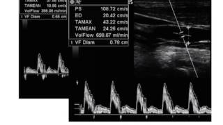 Ultrasound Podcast  CAROTID VTI PASSIVE LEG RAISE FOR VOLUME RESPONSIVENESS [upl. by Wichern]