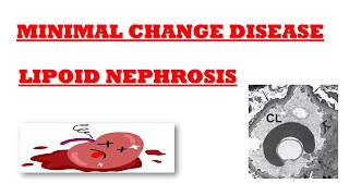 Minimal Change Disease  Nephrotic Syndrome  Lipoid Nephrosis  Simplified Explanation [upl. by Gothard]