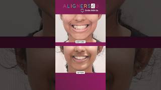 Your Aligners Journey From Start to Stunning Smile  Clear Aligners Braces  Hyderabad  India [upl. by Ahs493]