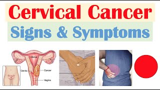 Cervical Cancer Signs amp Symptoms amp Why They Occur [upl. by Beret]