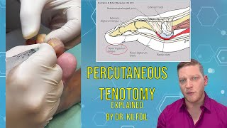 Percutaneous Tenotomy Explained  By Dr Roger Kilfoil ASMR Bonus at the end [upl. by Viafore695]