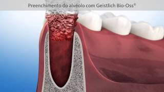 Tratamento de preservação óssea após extração dentária [upl. by Bianca408]