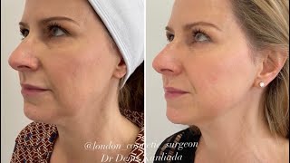 Endolift Best laser for non surgical face lift and neck lift [upl. by Llednor681]