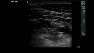 Bloqueio Infraclavicular guiado por ultrassommov [upl. by Almeta]