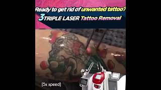 Tattoo removal l renewme skin clinic seoul skin clinic  dermatology [upl. by Hsaka739]