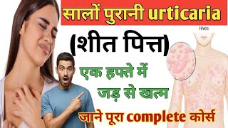 सालों पुरानी urticaria 30 दिन में जड़ से खत्म urticaria livcon capsule and assicon syrup urticaria [upl. by Tayib]