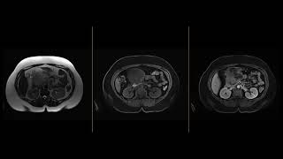 Pancreatic SPEN tumor [upl. by Elianore998]