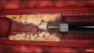 TurboElite laser atherectomy animation [upl. by Damal]