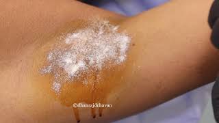 Excess Sweating of Underarms Treatment  Hyperhidrosis Botox Treatment  Dr Dhanraj Chavan Pune [upl. by Megen]