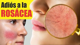 Tratamiento para la ROSÁCEA 🥵 Enrojecimiento y piel caliente 😡 TELAGECTASIAS en CARA 💋Dermatología [upl. by Yrral]