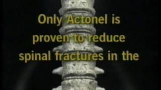 Actonel  Osteoporosis Medication Commercial  60 second Spot 2001 [upl. by Avi]