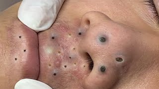 Big Cystic Acne Blackheads Extraction Blackheads amp Milia Whiteheads Removal Pimple Popping  1198 [upl. by Resiak]