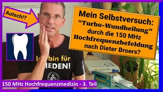 Mein schmerzhafter Selbstversuch Turbo Wundheilung möglich 150MHz Hochfrequenz nach Dieter Broers [upl. by Phonsa711]