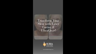 Transform Your Skin with Laser Coring amp UltraClear [upl. by Perseus]