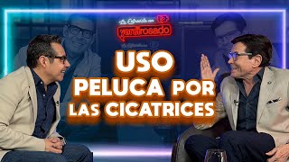 USO PELUCA por las CICATRICES  Juan José Origel  La entrevista con Yordi Rosado [upl. by Lancaster785]