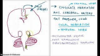 Easy Ways to Remember Cerebral Herniation [upl. by Petulia]