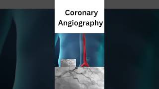 Coronary angiography  treatment of coronary heart disease [upl. by Raynor]